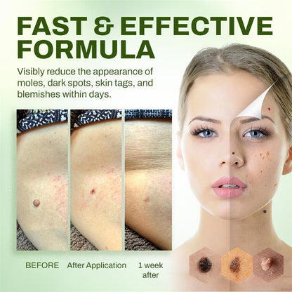 Seurico™ Fast Mole & Spot Removal Cream
