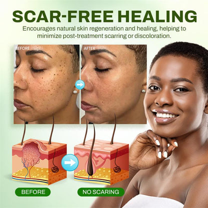 Seurico™ Fast Mole & Spot Removal Cream