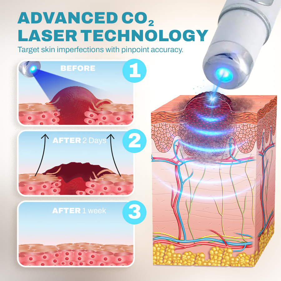 🔥NEGUSY™ CO₂ Laser Precision Pen: Advanced Mole & Wart Removal