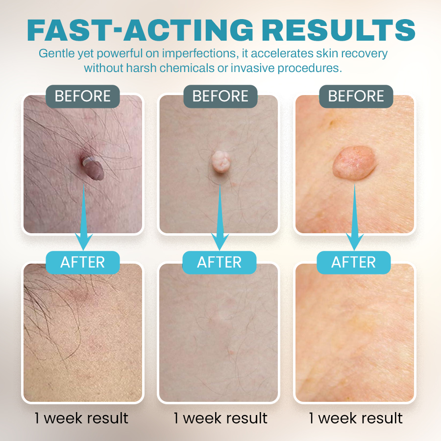 🔥NEGUSY™ CO₂ Laser Precision Pen: Advanced Mole & Wart Removal