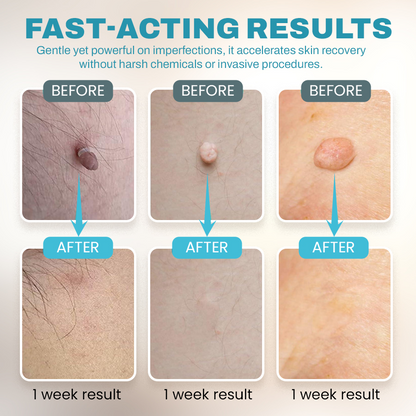 🔥NEGUSY™ CO₂ Laser Precision Pen: Advanced Mole & Wart Removal