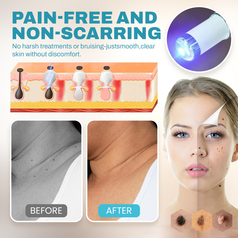 🔥NEGUSY™ CO₂ Laser Precision Pen: Advanced Mole & Wart Removal
