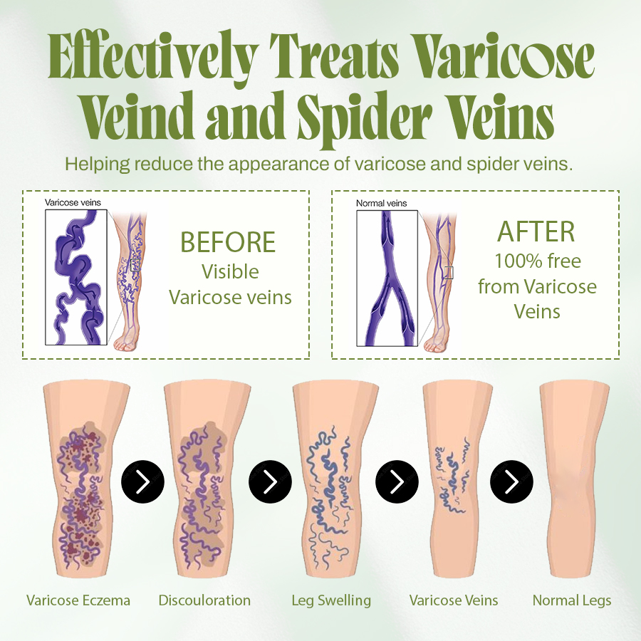 🍃Seurico™ Vein Relief Cream🍃