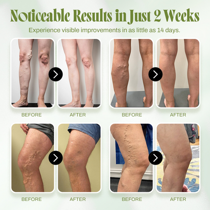 🍃Seurico™ Vein Relief Cream🍃