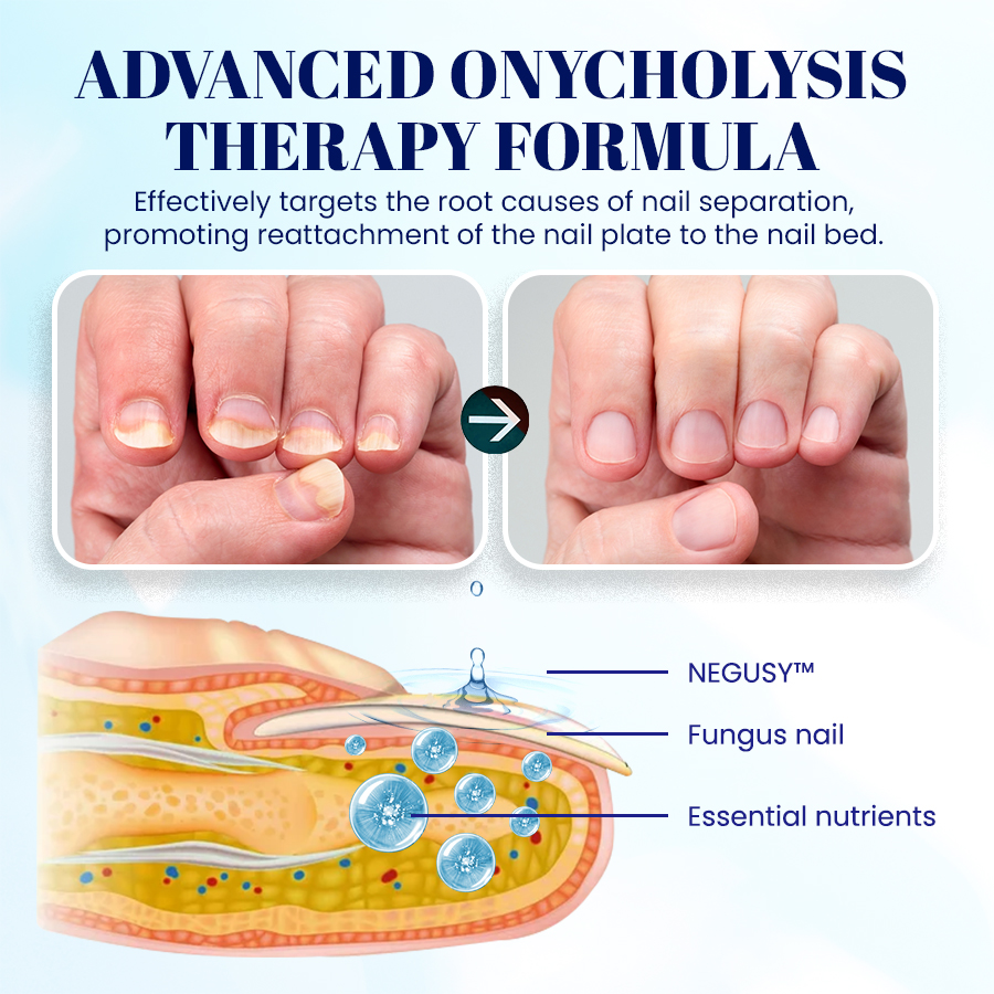 NEGUSY™ Nail Onycholysis Treatment
