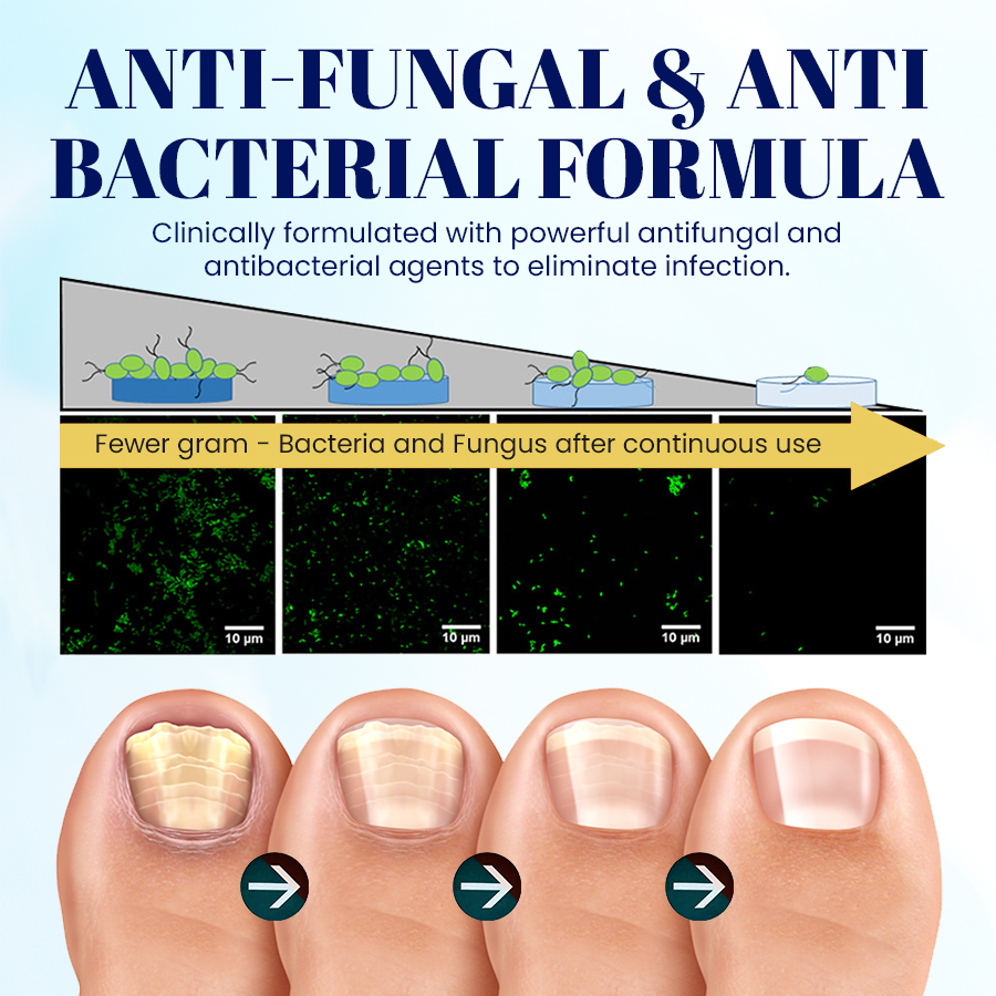NEGUSY™ Nail Onycholysis Treatment
