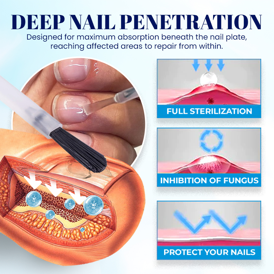 NEGUSY™ Nail Onycholysis Treatment