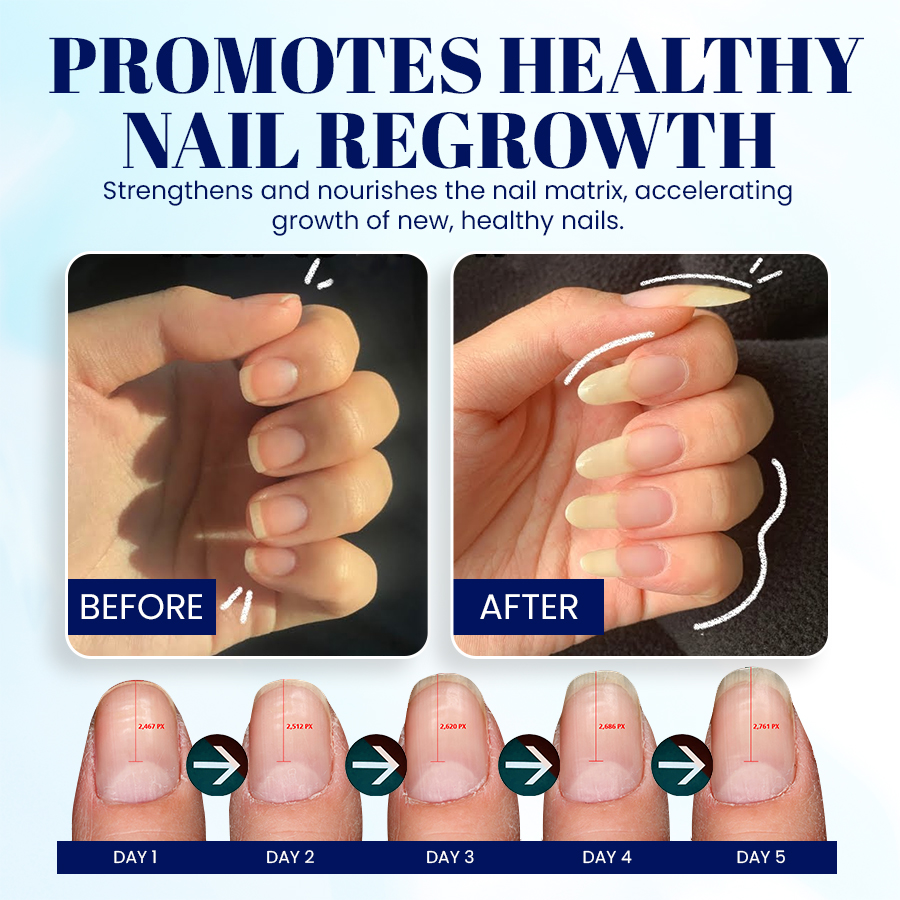 NEGUSY™ Nail Onycholysis Treatment