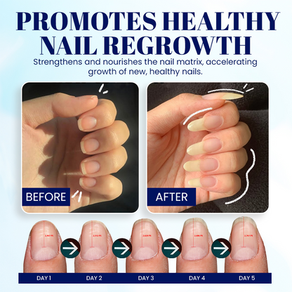 NEGUSY™ Nail Onycholysis Treatment