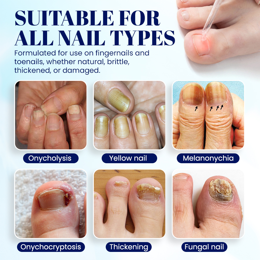 NEGUSY™ Nail Onycholysis Treatment