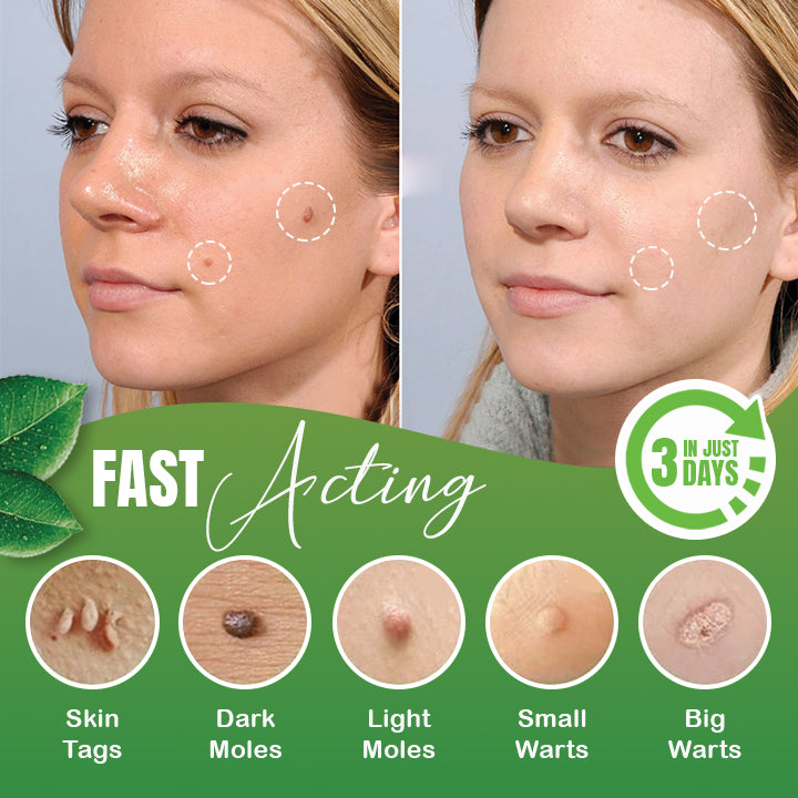 Skin Tag/warts Herbal Removal Patch
