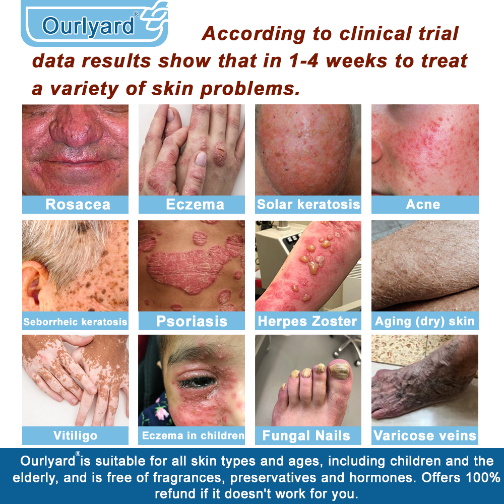 ✅Mayo Clinic Official: Magnesium skin repair cream (Eczema and Psoriasis Relief, Skin Repair, Even Tone, Acne and Dark Spot Treatment, Wart and Mole Removal)