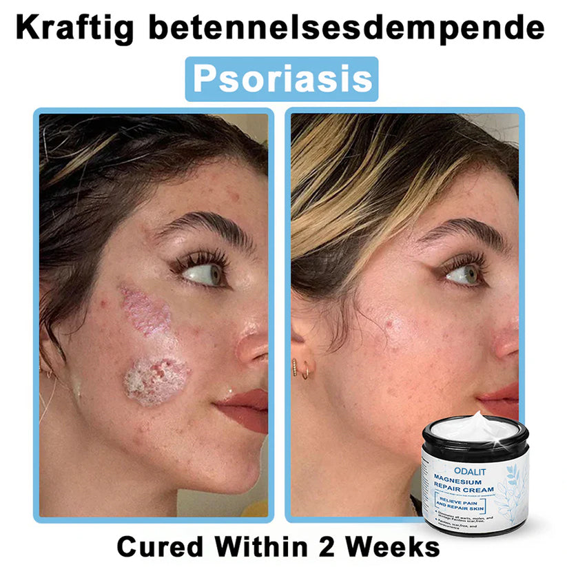 🏆✅Mayo Clinic Official: Magnesium skin repair cream (Eczema and Psoriasis Relief, Skin Repair, Even Tone, Acne and Dark Spot Treatment, Wart and Mole Removal)