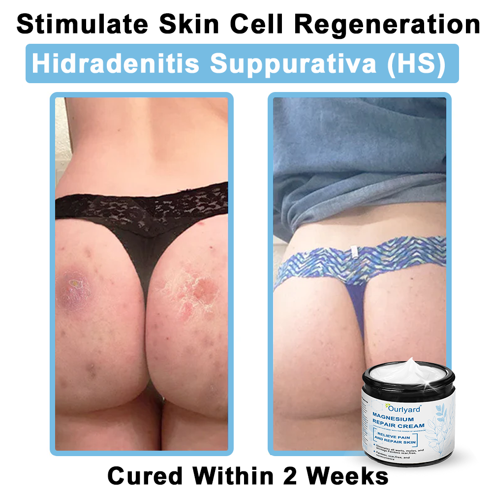 ✅Mayo Clinic Official: Magnesium skin repair cream (Eczema and Psoriasis Relief, Skin Repair, Even Tone, Acne and Dark Spot Treatment, Wart and Mole Removal)