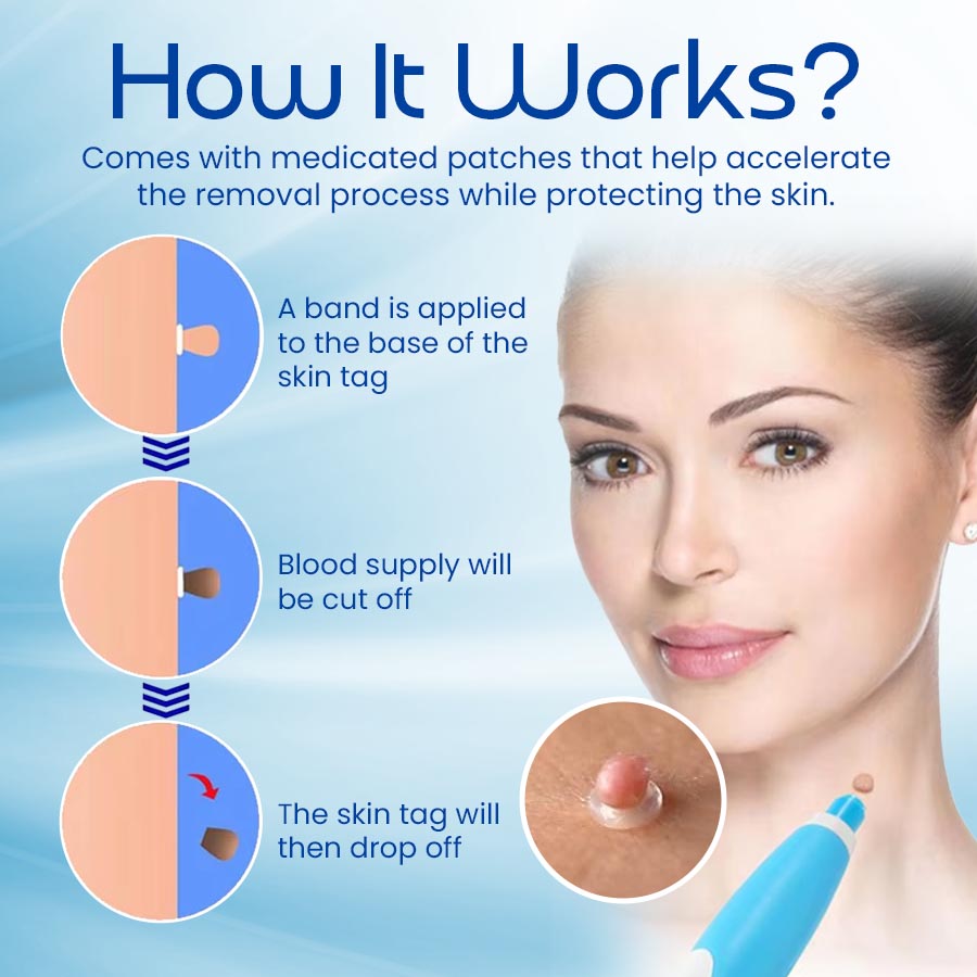 Skin Tag Remover